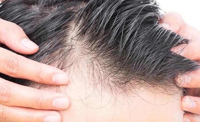 برای درمان ریزش مو چه ویتامینی بخوریم